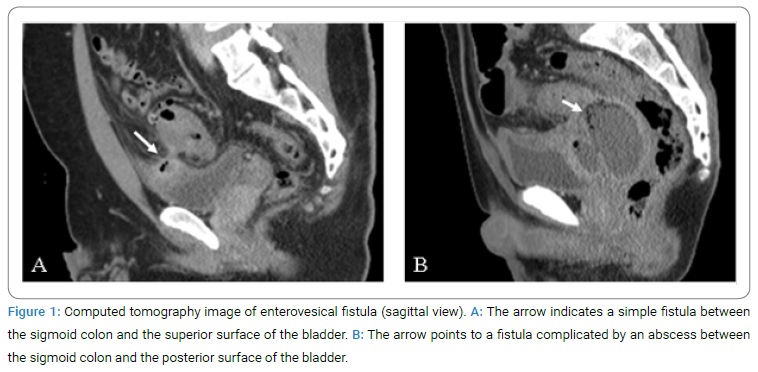 Bladder Fistula Resection And Separation For Enterovesical Fistula Due 