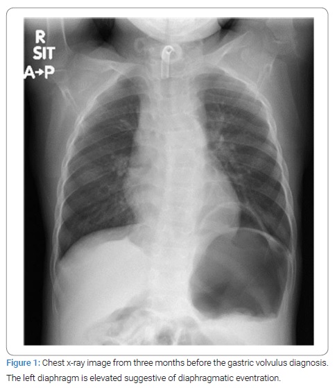 Volvulus Xray Gastric Volvulus Applied Radiology