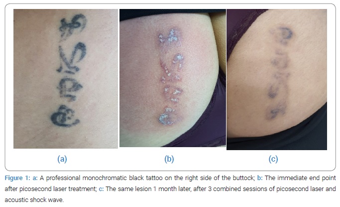 Combined Picosecond Laser Tattoo Removal with an Acoustic Shock Wave  Device: A Case Series - Clinical Case Reports Journal (ISSN 2767-0007)