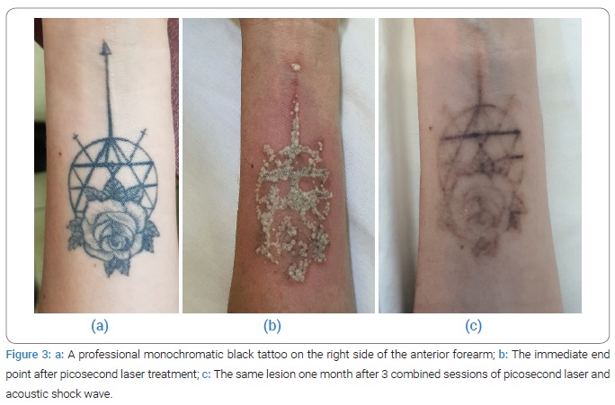 Everything youve ever wanted to know about laser tattoo removal  Dazed