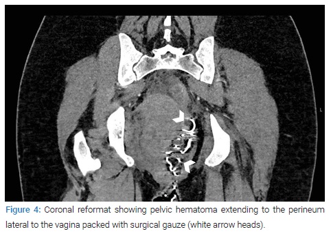 pelvic hematoma symptoms