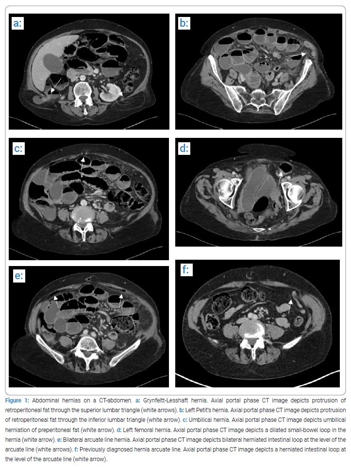 Umbilical hernia, Radiology Case