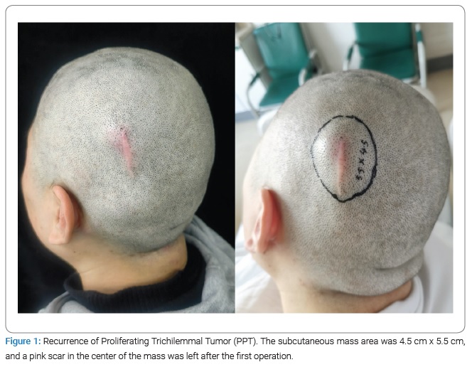 Proliferating Trichilemmal Tumor of the Scalp: A Case Report and Literature  Review - Clinical Surgery Journal (ISSN 2767-0023)
