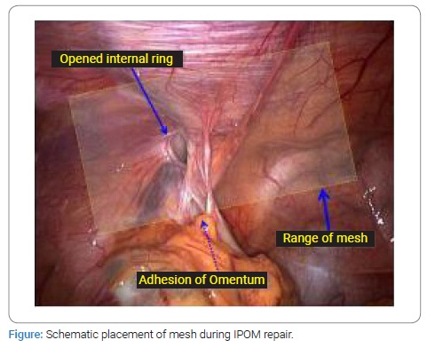 Laparoscopic Intraperitoneal Onlay Mesh (IPOM) Repair in Management of  Inguinal Hernia: A Retrospective Cohort Study - Clinical Surgery Journal  (ISSN 2767-0023)