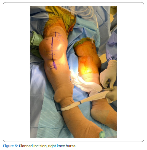 Bursectomy knee complications, monster concursos gcm serra 